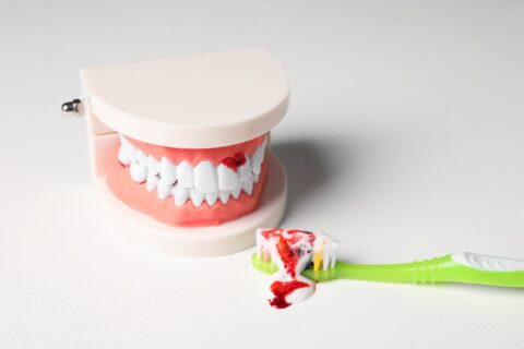 Dental model showing bleeding gums during brushing demonstration in Columbus, OH